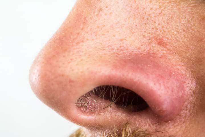 If You Do That, You Will Finally Get Rid Of Blackheads On Your Nose